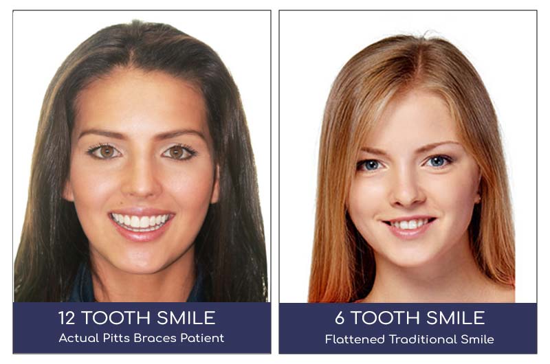 Braces 12 Tooth Smile 12 tooth smile vs 6 tooth smile from braces