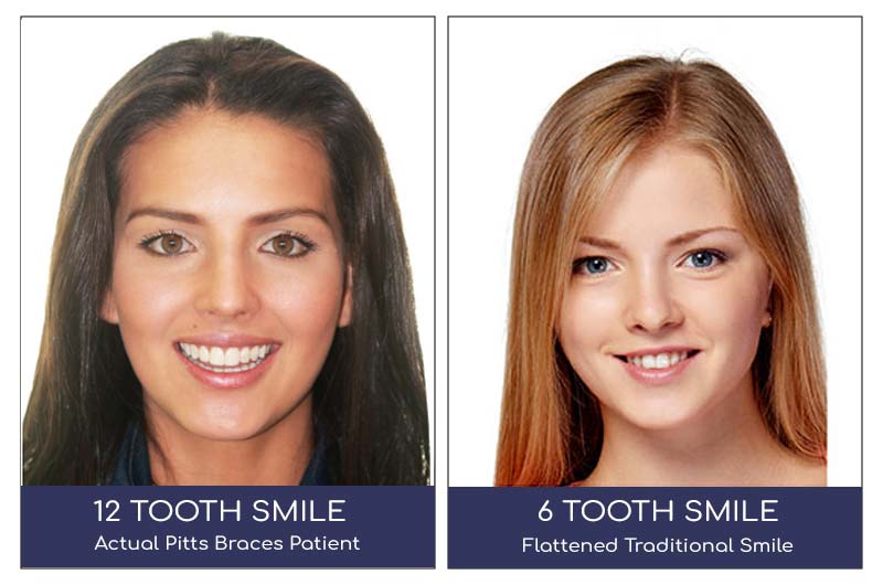 12 tooth smile vs 6 tooth smile from braces