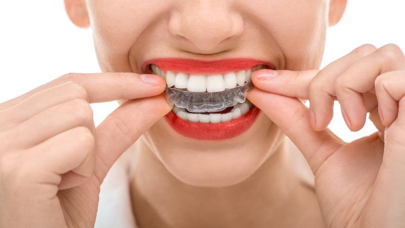 Woman putting in invisalign tray