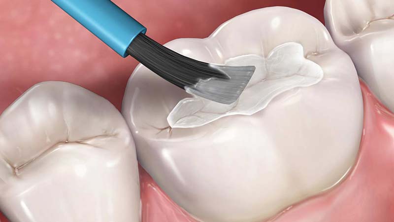 Dental Sealant application