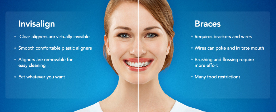 Invisalign benefits over braces