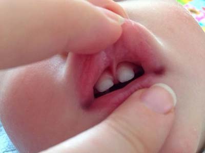 lip tie on infant infant lip tie