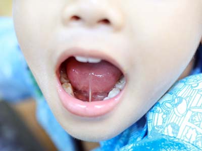 tongue tie on kid tongue tie