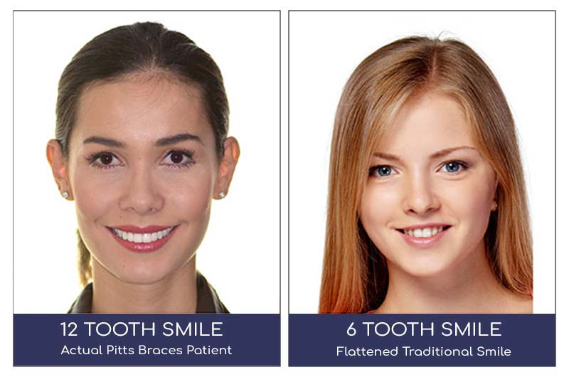 before and after braces adults