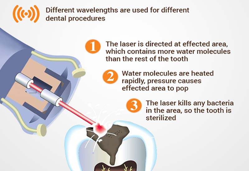 how laser dentistry works on cavities