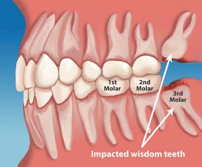 Impacted third molar Impacted wisdom teeth