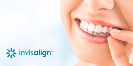 Woman putting invisalign trays in mouth