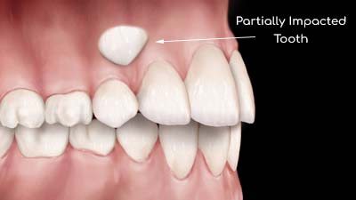 Partially Impacted Canine Tooth Illustration Partially Impacted Tooth Illustration