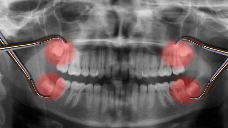 Wisdom Teeth Shown in XRay