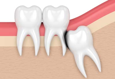 Erosion Cavity from Wisdom Tooth