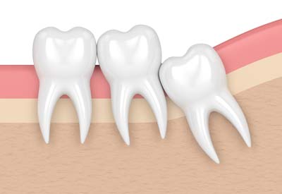 Crowding Teeth from Wisdom Tooth