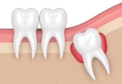 Wisdom Tooth Cyst