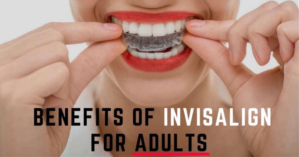 Benefits of Invisalign Treatment for Adults