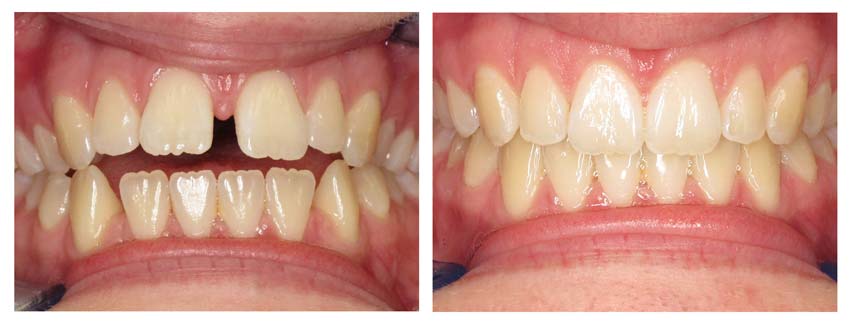 Before & After Invisalign - Real Patient Results