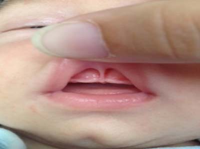 Lip Tie on Infant