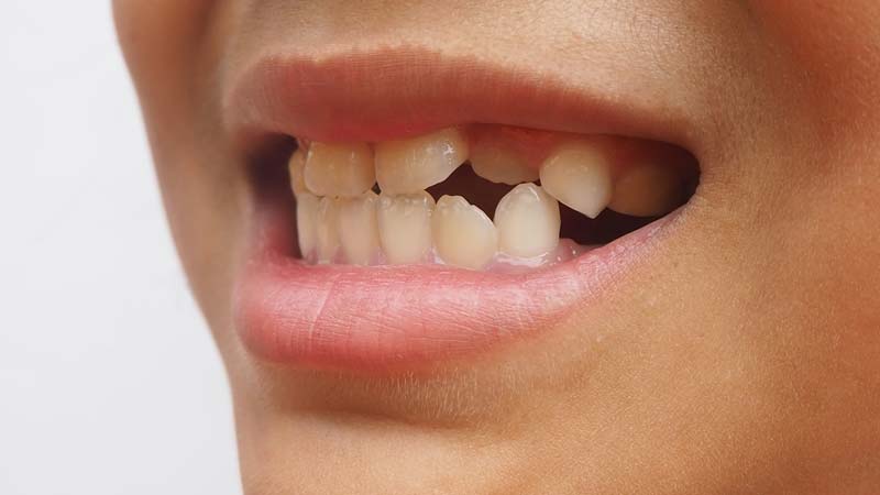 Hyperdontia Extra Teeth Hyperdontia Extra Teeth