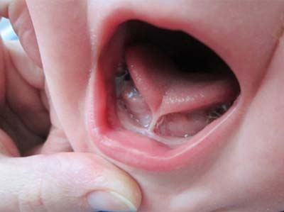 Tongue Tie Tongue Tie