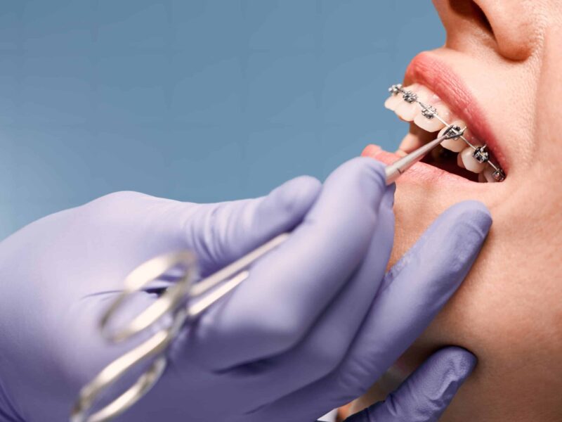 Orthodontics St. Charles