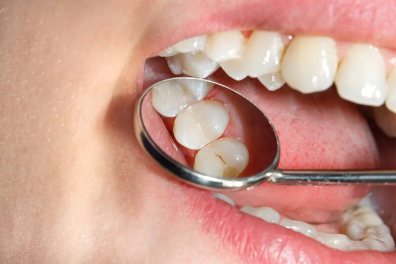 Dental Sealants St. Charles