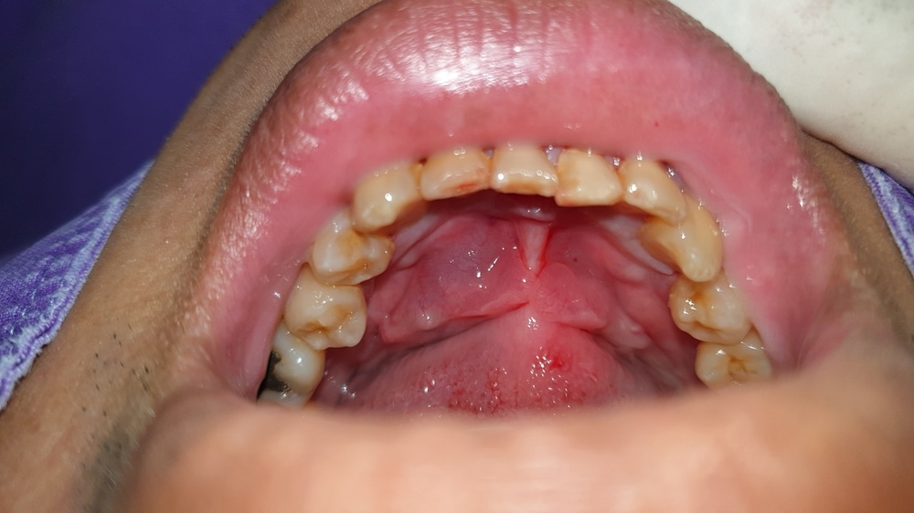 frenectomy for lip tie